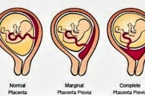 PLASENTA PREVIA NEDİR?